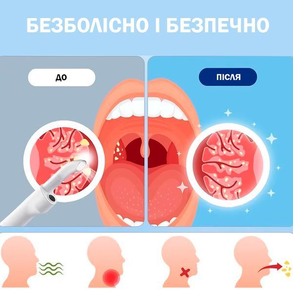 Електричний вакуумний набір з камерою для видалення тонзилолітів Інструмент для видалення каменя з мигдалин з підсвіткою і насадками 117431 фото